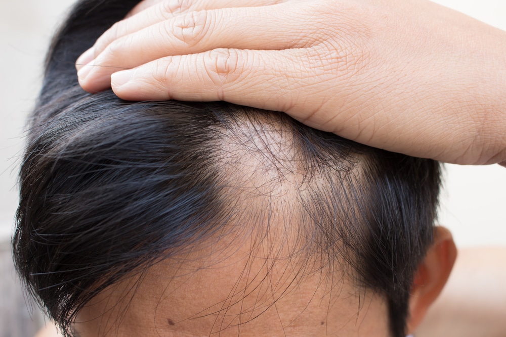 Does Menopause Trigger Hair Loss: Hormonal Modifications 101