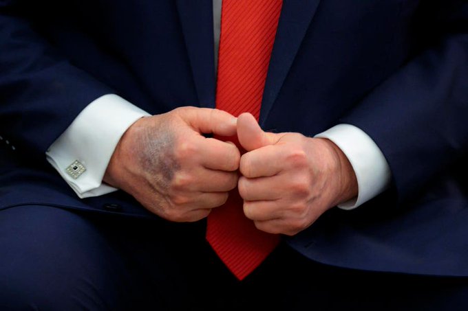 Trump bruised hand